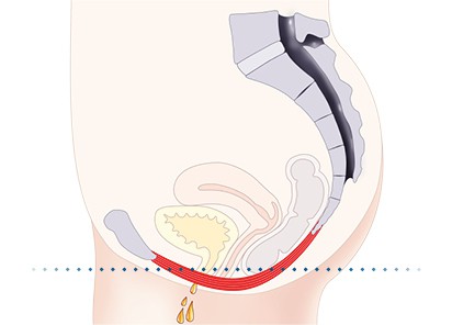Pelvic-Floor Muscle Repair 5 Pelvic floor muscles Bradford