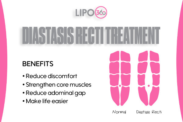 Revolutionising Muscle Repair: The Power of LIPO360 Body Sculpt Post-Injury 5 diastasis recti treatment Bradford