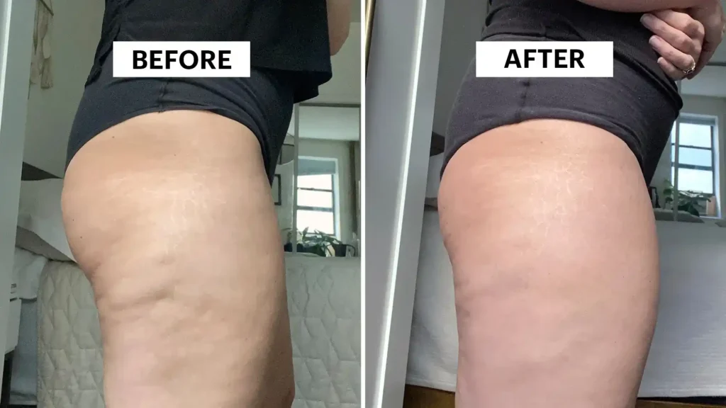 Do Toning Exercise Bradford Really Tackle Cellulite?