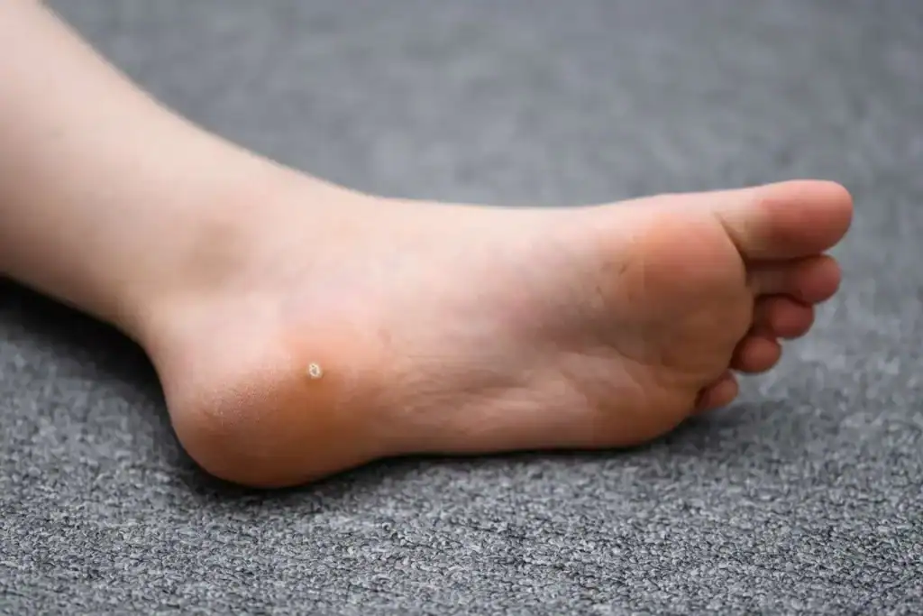 Image of verruca on the bottom of the foot that able to be treated with Cryotherapy Bradford