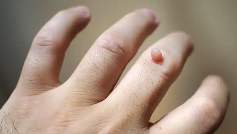 Image of blemish that Cryotherapy Bradford can remove with Lipo 360.
