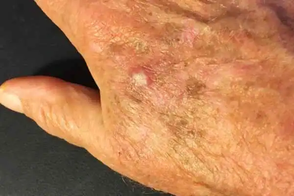 Cryopen For Actinic Keratoses 1 Image of Actinic keratoses Bradford on a person hand