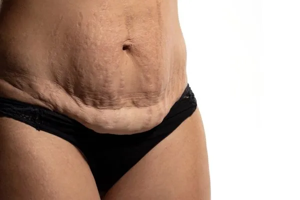 The science behind skin tightening Bradford picture of a woman's sagging skin on the stomach